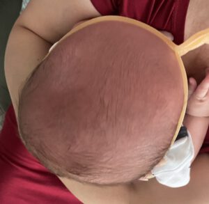 Afplatting baby hoofd